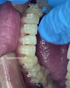 Stripping , interproximal reduction 醴✨ Interproximal reduction is the practice of mechanically removing enamel from between the teeth to achieve orthodontic ends, such as to correct crowding, or reshape the contact area between neighboring teeth. . Case by @marycheje.ec | Dentistry blog | Facebook