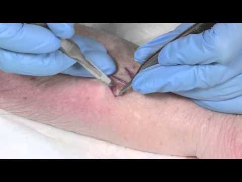 How to Suture - part 4: the Z plasty