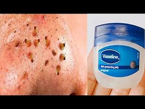How to remove blackheads and Whiteheads from nose and face naturally at home.