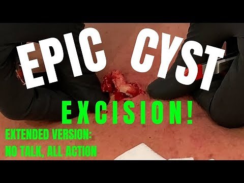 EPIC CYST EXCISION! EXTENDED VERSION: NO TALK, ALL ACTION