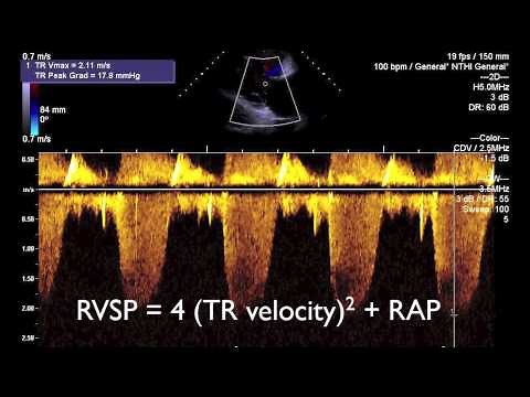 Transthoracic echo (TTE) for beginners