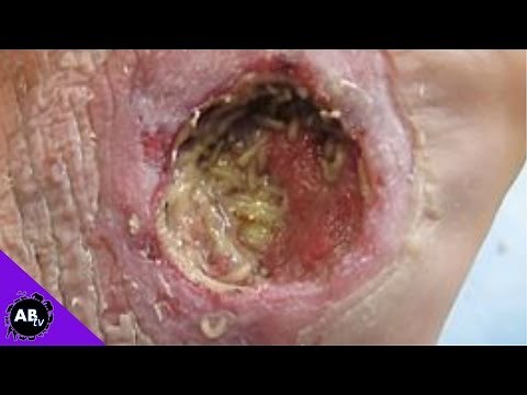 Maggots Inside My Foot! 5 Weird Animal Facts