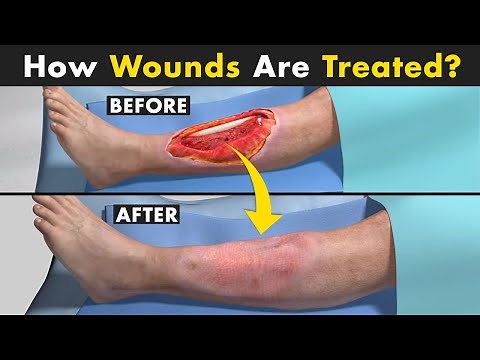 Wound Debridement Procedure | Unbelievable Ways Doctors Treat Wounds!