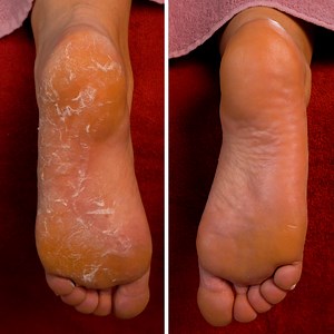 53K views · 143 reactions | Feet treatment for ultimate comfort | MetDaan Beauty | Facebook