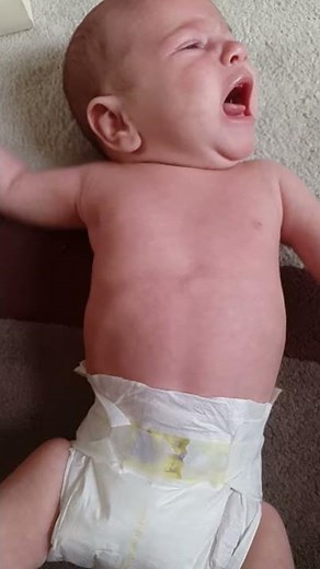 Chest Retractions Associated With Laryngomalacia