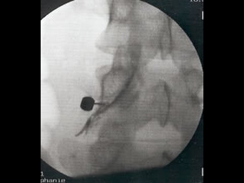 The Pain Show - Sciatica & Epidural Steroid Injections