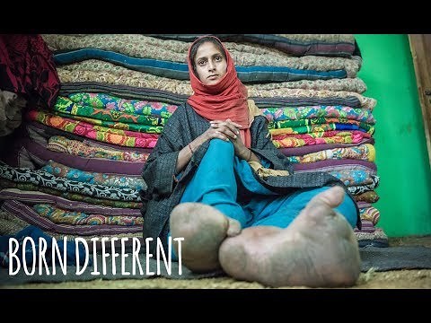 The Woman With The Giant Feet | BORN DIFFERENT