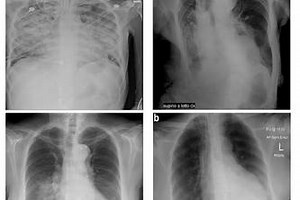 DTL-COVID: COVID-19 Prediction from Chest X-ray