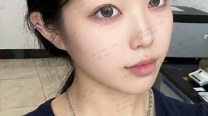 眼窝凹陷能做双眼皮吗？美莲沙新力案例，6mm窄双开扇术后！