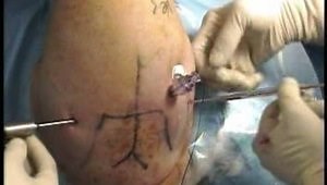 SLAP Tear Single Anchor Double Suture Repair Using the "Stitch of Burns"