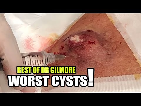 Speedy Back Cyst: Dr. Gilmore's Worst Extractions