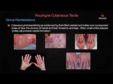 Porphyria cutanea tarda (PCT) - Biochemistry usmle step 1 webinar lecture