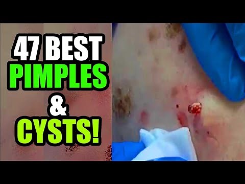 47 Big Blackheads, Cysts, Pimples and Whitehead Pops! Acne, Zits & Popping