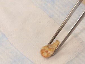 Development of a Direct Pulp-capping Model for the Evaluation of Pulpal Wound Healing and Reparative Dentin Formation in Mice