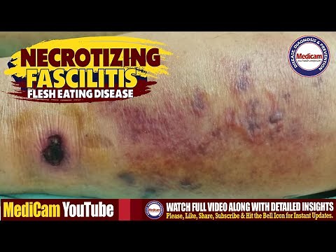 Necrotizing Fasciitis (Flesh-Eating Disease) Explained | Causes, Symptoms, & Treatment