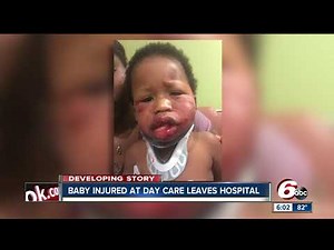 Baby Jesse released from Riley Hospital after being injured at Indy daycare