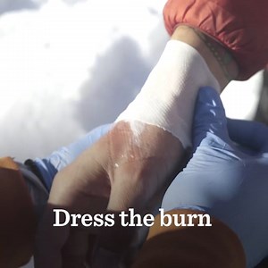 Essential skills for backcountry adventures: treating small burns on the go! 🏞️🔥 Stay prepared with these wilderness first aid burn tips from NOLS Wilderness Medicine! #NOLSWildernessMedicine #Backcountry #WFR | NOLS