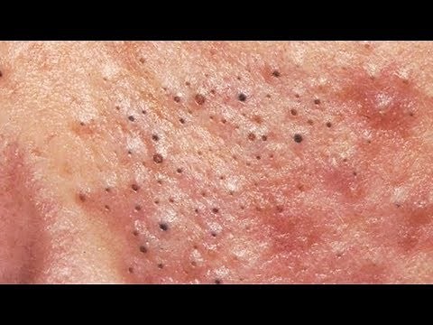 How To Get Rid Of Pimple Under Skin At Home ✦ Dr Laelia ✦