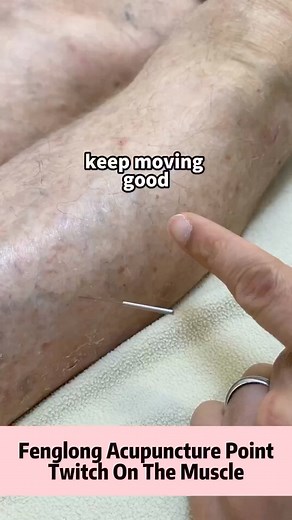When inserting a needle into the Fenglong acupuncture point, it may...