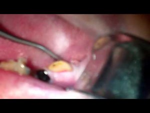 Infected tooth spreads bacteria and pus
