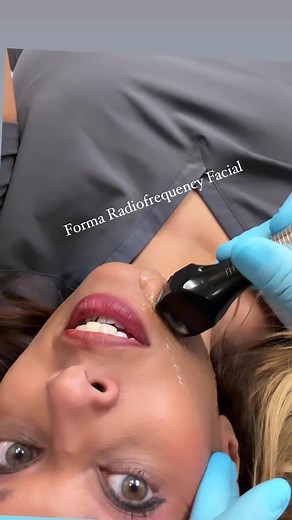 Forma Radiogrequency treatment #tighten #skin #lift #collagen #glowup #antiaging #susacharmd #forma
