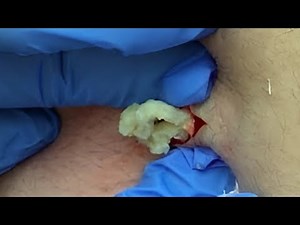 Massive Epidermal Cyst on Lower Back Gets Drained – Pus Explosion!