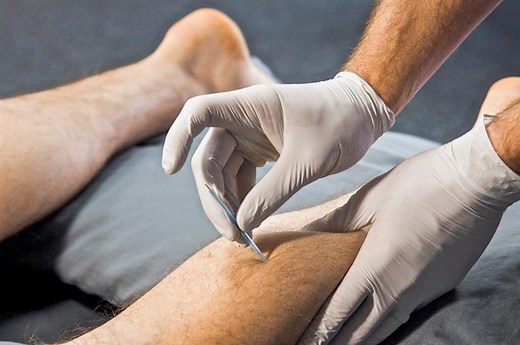 Functional Dry Needling® Specialist Certification • Programs by EIM | Evidence In Motion