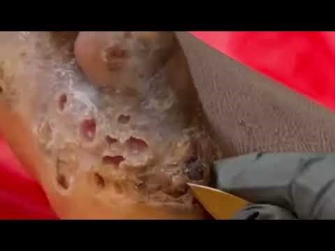 Jigger Removal from Foot & Leg 😱 | Real Jigger Digging Treatment | Satisfying Cleaning Video