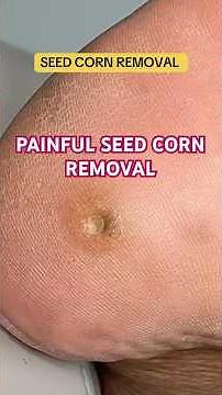 REMOVING A SEED CORN