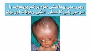 Neural tube defects بچوں میں پیداٸیشی کمر کا پھوڑا ,سر میں پانی کا مسلہ اور اس سے بچاٶ!!!!! تمام شادی شدجوڑں کواسکا علم ہونا چا ہیے۔ | Dr. Arshad Mehmood - Child Specialist