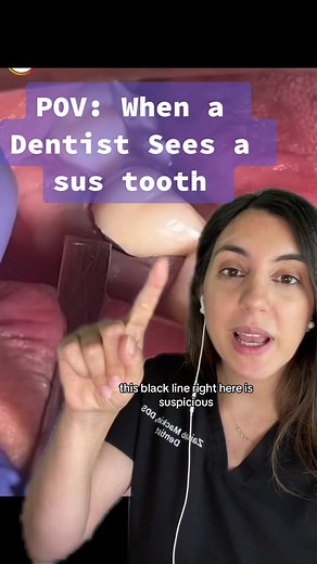 When a tooth looks suspicious! 🔍 #dentist #cavitycheck #dentalcrown #dentalextractions #niceteeth BG video: source unknown. Please DM me for credit.