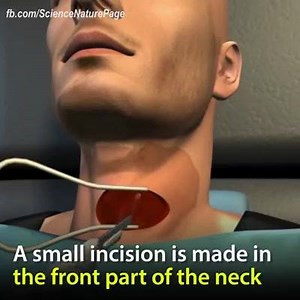 16K views · 308 reactions | Cervical Spine Disc Replacement Surgery !!!! Awesome !!! | Desi Medicos | Facebook