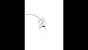 Semitendinosus Hamstring Harvest Demonstration in a Cadaver