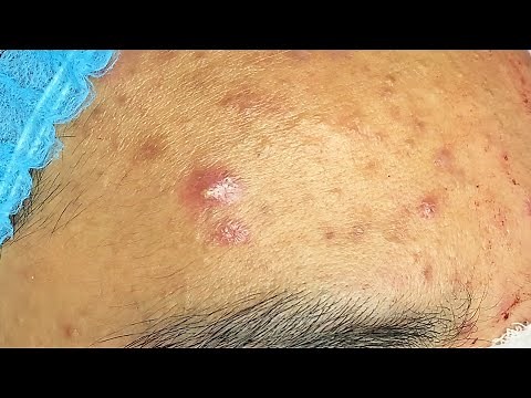 Extraction boutons et l'acné kystique sur le front