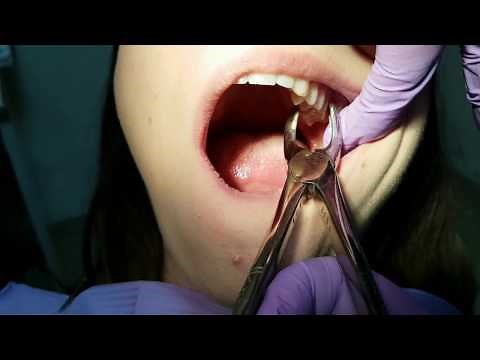 TOOTH EXTRACTION - how to use dental forceps [ Shown on a patient ]