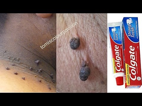 REMOVE SKIN TAGS OVERNIGHT WITH TOOTHPASTE