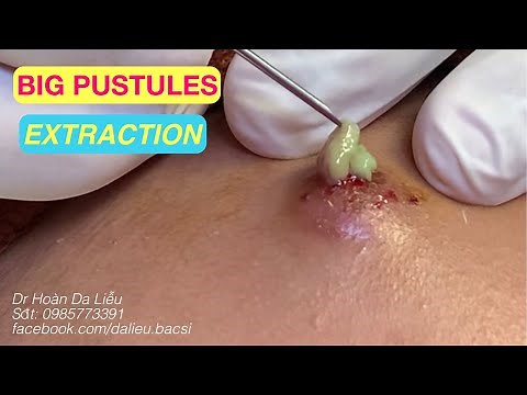 Mụn trứng cá siêu to nhọt|Dermatologist, big pimples, blackhead, anti acne, big pustule extraction