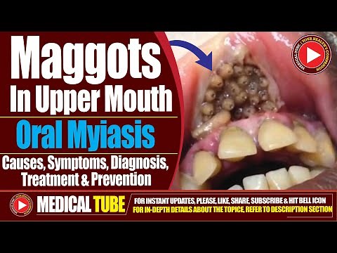 Maggots in Upper Mouth | Oral Myiasis | Causes Diagnosis and Treatment