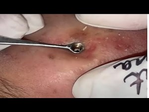 Deep Facial Cleansing Removal FULL VIDEO by Dr.Lalit Kasana 03