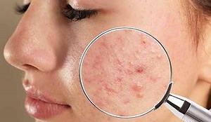 Tips For Acne Free Face: Skincare & Prevention