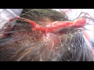 Scalp Abscess