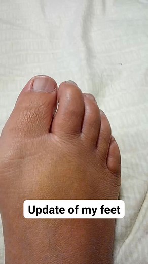 Update of my feet😍promise I'm going to go to the closest nail salon this week if I get 500 followers | Joy Roberts