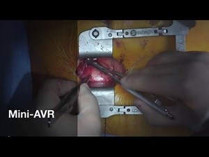 Minimally Invasive Aortic Valve Replacement • Video • MEDtube.net