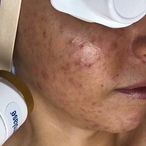 Topicals and medication are not your only solution to acne breakouts. NeoClear by Aerolase Laser Therapy is available at a medical practitioner near you. Find a NeoClear practitioner in your area - send us a message | Aerolase