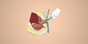 Dilation And Curettage (D&C) Nursing Care Plan & Management - RNpedia
