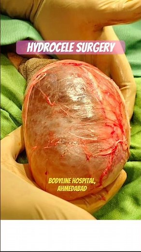 Large Hydrocele repair by ‪@drutsavshahurologist‬ at Bodyline hospital #hydrocele #surgery #surgeon