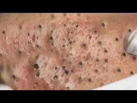 How To Remove Blackheads And Whiteheads On Face Easy #88 ✦ Dr Laelia ✦