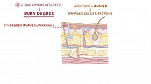 Video: Burns - Video Explanation! | Osmosis | Osmosis