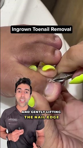 How to Treat and Prevent Ingrown Toenails