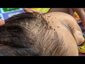 Remove all thousand lice from head - Take out all of big lice from hair